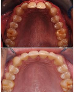 ortodoncia invisible para solucionar apiñamiento y maloclusion