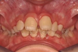 Ortodoncia con brackets niños valencia