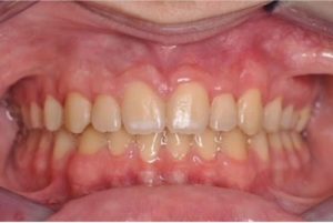 ortodoncia con brackets niños valencia