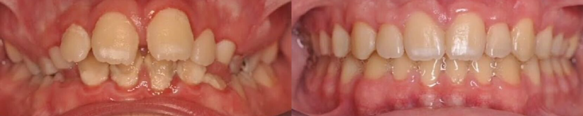 Ortodoncia con brackets y mucho amor para resolver mordida y enfermedad periodontal severa
