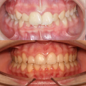 Antes y después de ortodoncia infantil
