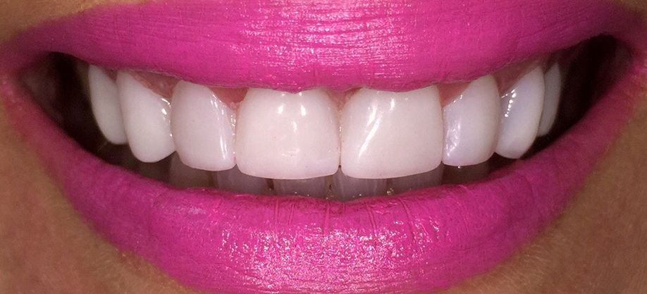 Cómo elegir el mejor tratamiento de blanqueamiento dental