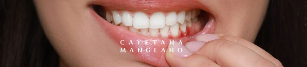 gingivitis